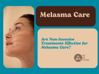 Are Non-Invasive Treatments Effective for Melasma Care?
